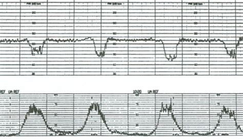 fetal monitoring strips practice|fetal monitor strip test Flashcards .
